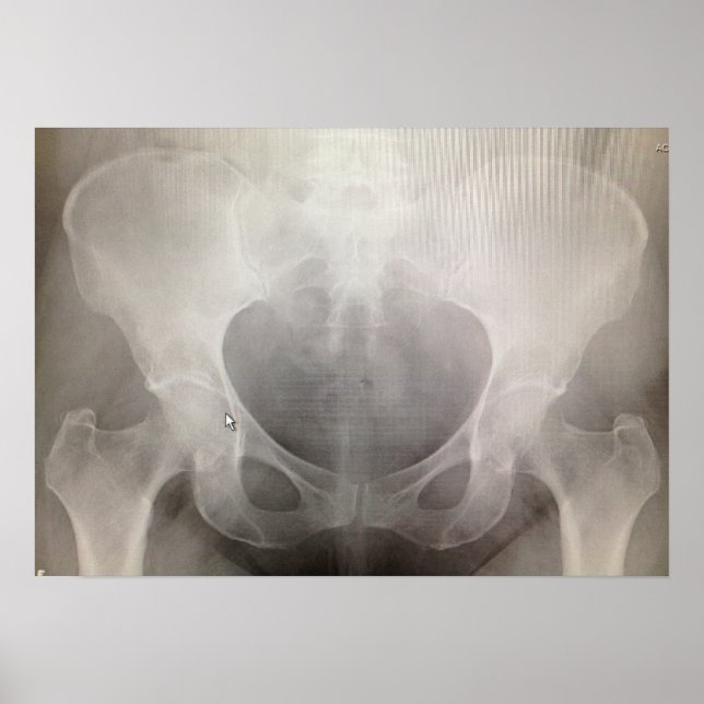Pelvis X-ray Poster (Front)