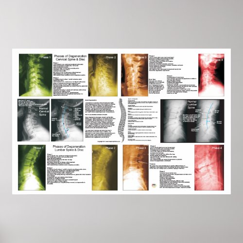 Phases Cervical Lumbar Spinal Degeneration Poster