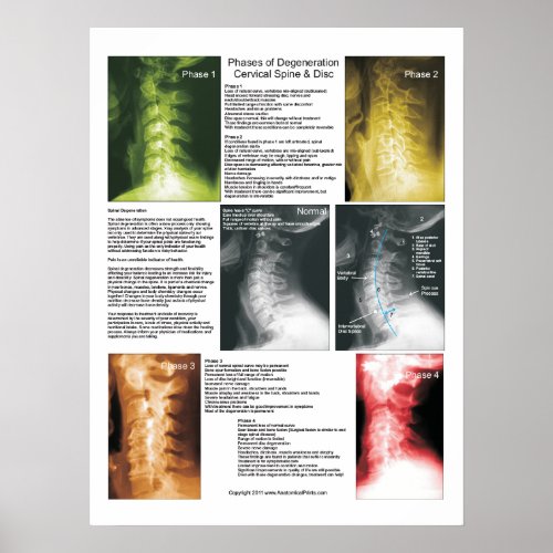 Phases Cervical Spinal Degeneration Poster
