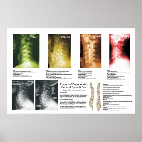 Phases Cervical Spinal Degeneration Poster