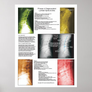 Phases Lumbar Spinal Degeneration Poster