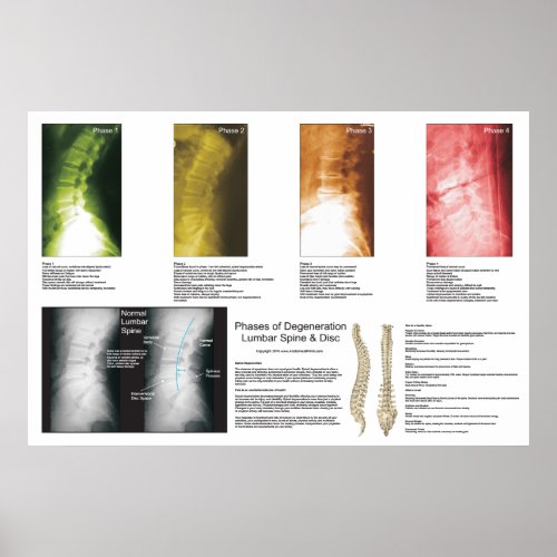 Phases Lumbar Spinal Degeneration Poster