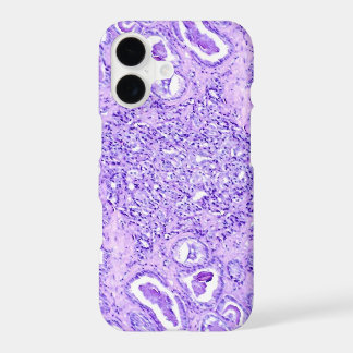 Phone Case(many models)-Prostate Cancer Cells iPhone 17 Case