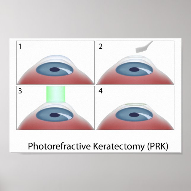 Photorefractive Keratectomy (PRK) poster (Front)
