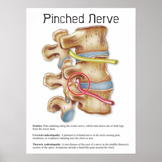 Pinched Nerve Physical Therapy Chiropractic Chart (Front)