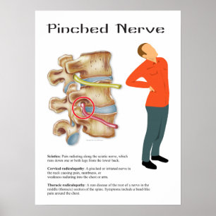 Pinched Nerve Physical Therapy Chiropractic Chart