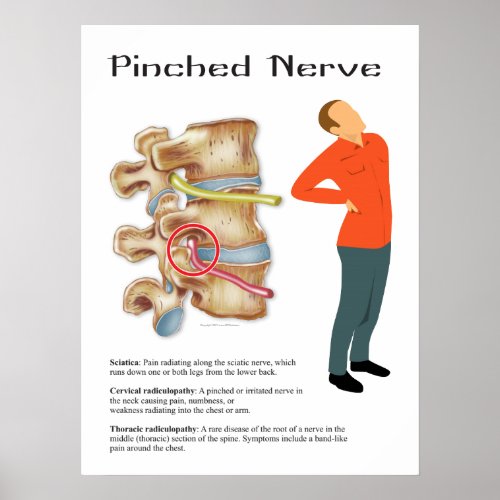 Pinched Nerve Physical Therapy Chiropractic Chart