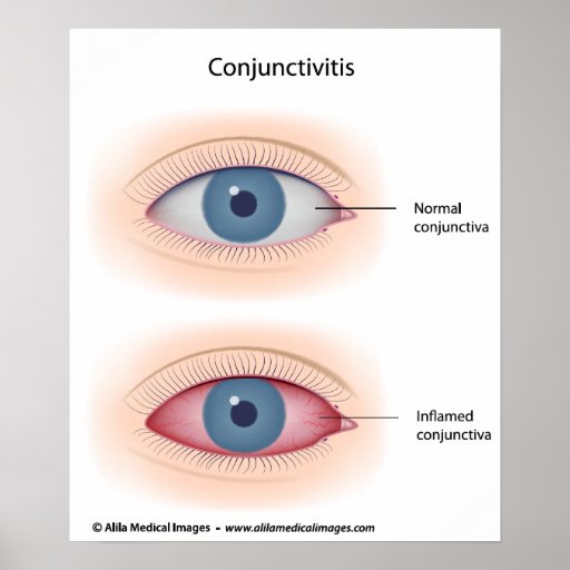 Pink eyes disease, labeled diagram. print | Zazzle