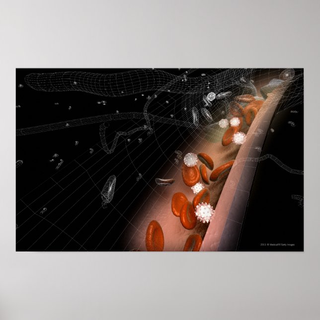 Plaque in the arteries poster (Front)