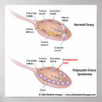 Polycystic ovary syndrome, labeled diagram. poster