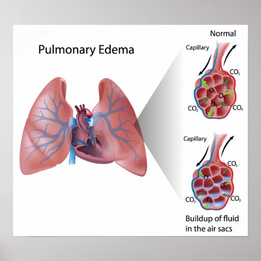 Pulmonary edema Poster | Zazzle