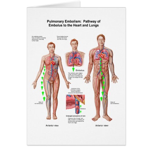 Pulmonary Embolism Pathway Of Embolus