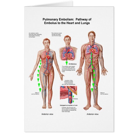 Pulmonary Embolism, Pathway Of Embolus Cards (Front)