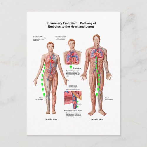 Pulmonary Embolism Pathway Of Embolus Postcard