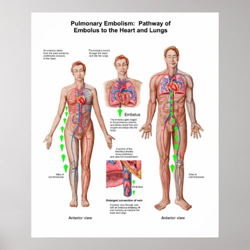 Pulmonary Embolism Pathway Of Embolus Poster