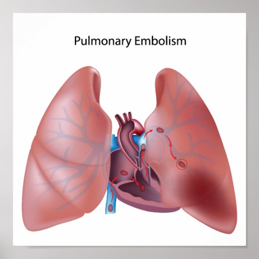 Pulmonary embolism Poster | Zazzle