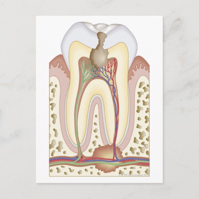 Pulp and Root Abscess Postcard (Front)