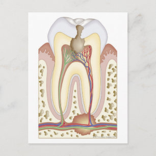 Pulp and Root Abscess Postcard