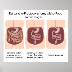 Restorative proctocolectomy with j-pouch 2 stages poster