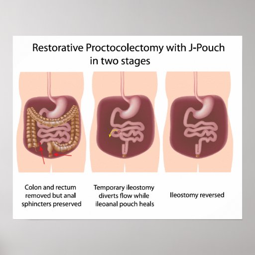 Proctocolectomy restorative coloproctectomy restorative