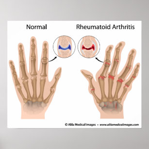 Rheumatoid Arthritis Posters & Prints | Zazzle