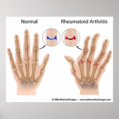 Rheumatoid arthritis of finger joints diagram poster