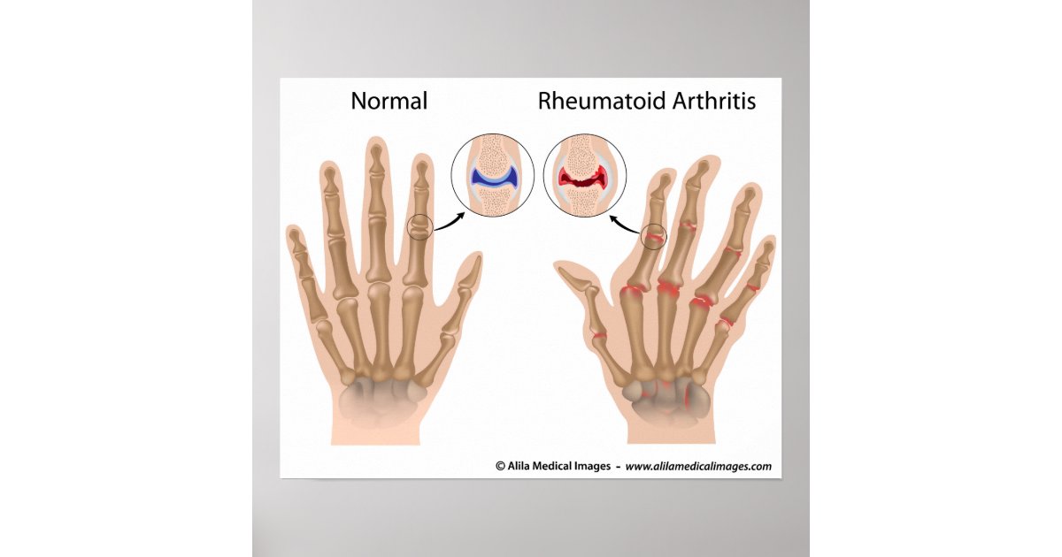 Rheumatoid arthritis of finger joints, diagram. poster | Zazzle