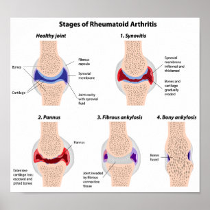 Rheumatoid arthritis Poster