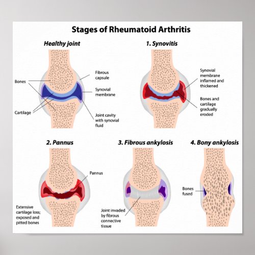 Rheumatoid arthritis  Poster