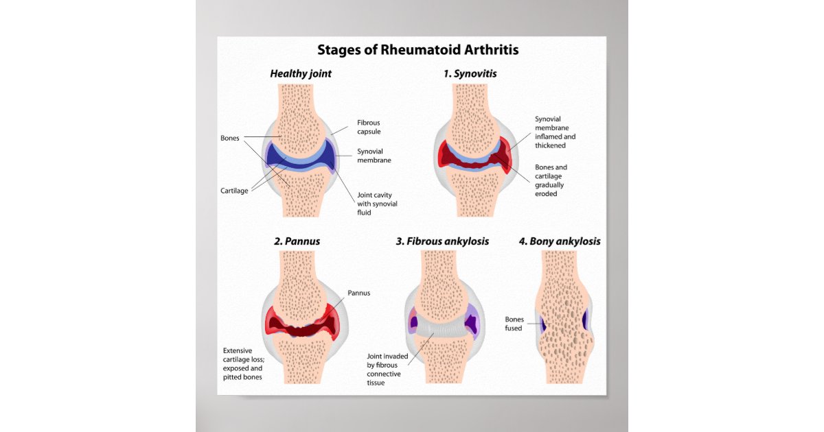 Rheumatoid arthritis Poster | Zazzle