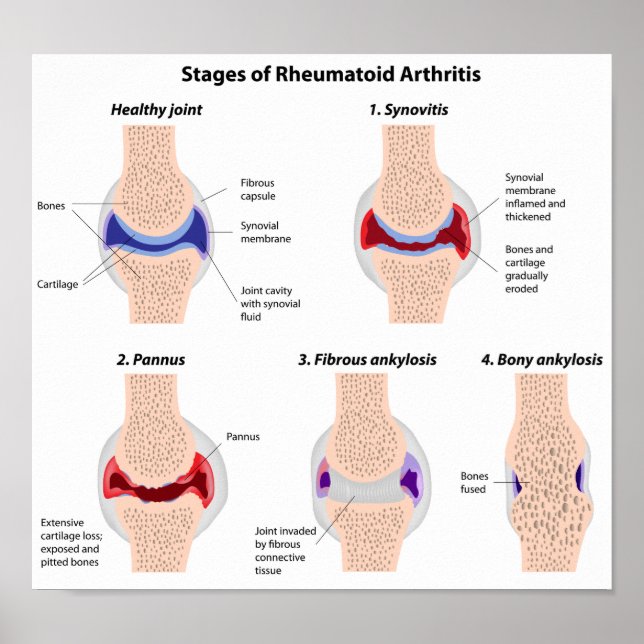 Rheumatoid arthritis  Poster (Front)