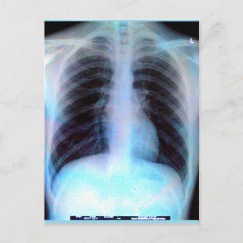 Ribcage Xray Skeleton Postcard