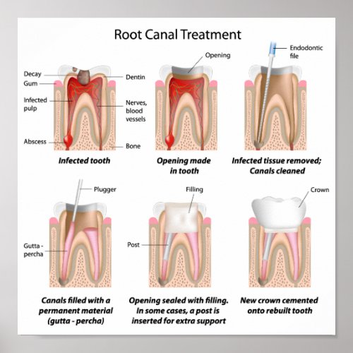 Root canal treatment Poster