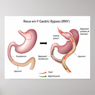 Roux-en-Y Gastric Bypass surgery poster