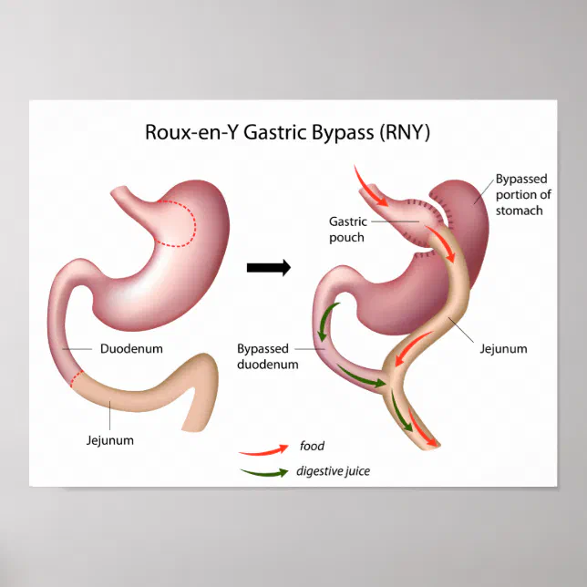 Roux-en-Y Gastric Bypass surgery poster | Zazzle