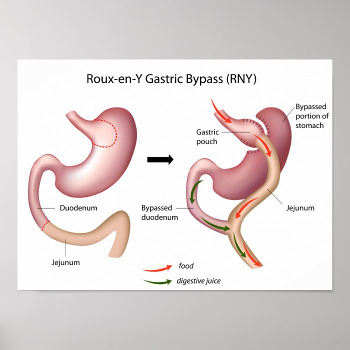 Roux en Y Gastric Bypass surgery poster