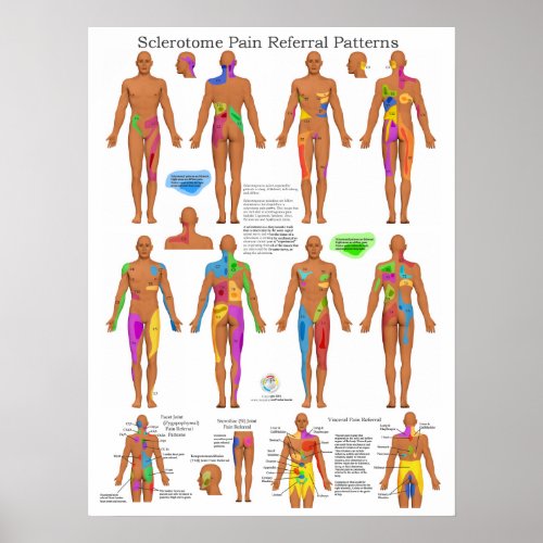 Sclerotome Joint Pain Referral Poster Chiropractic