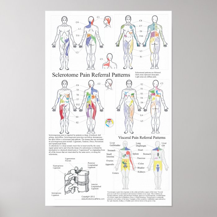 Sclerotome Visceral Pain Referral Chart Poster