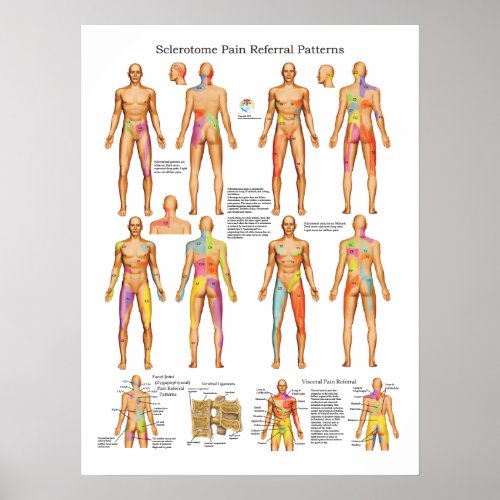 Sclerotome Visceral Pain Referral Poster