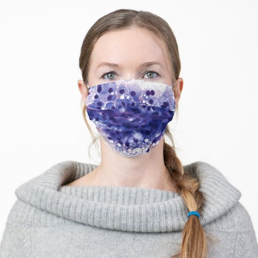 Secretory Carcinoma, Parotid Face Mask (Worn)