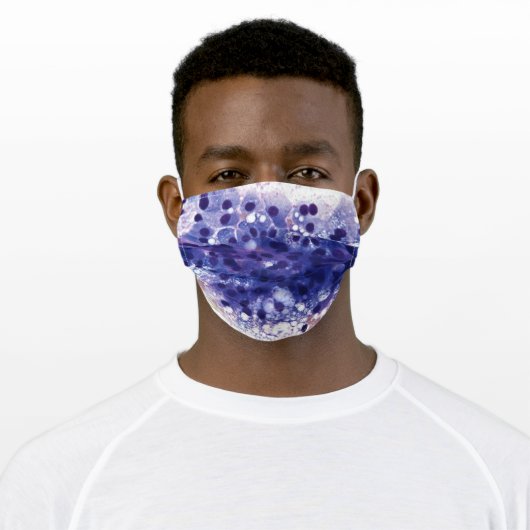 Secretory Carcinoma, Parotid Face Mask (Worn)