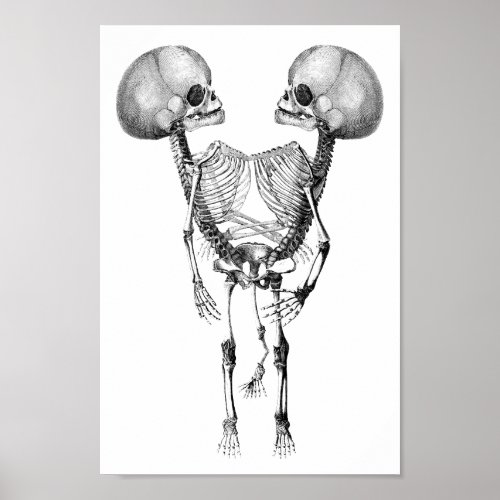 Siamese conjoined Twins Anatomy Skeletons art Poster