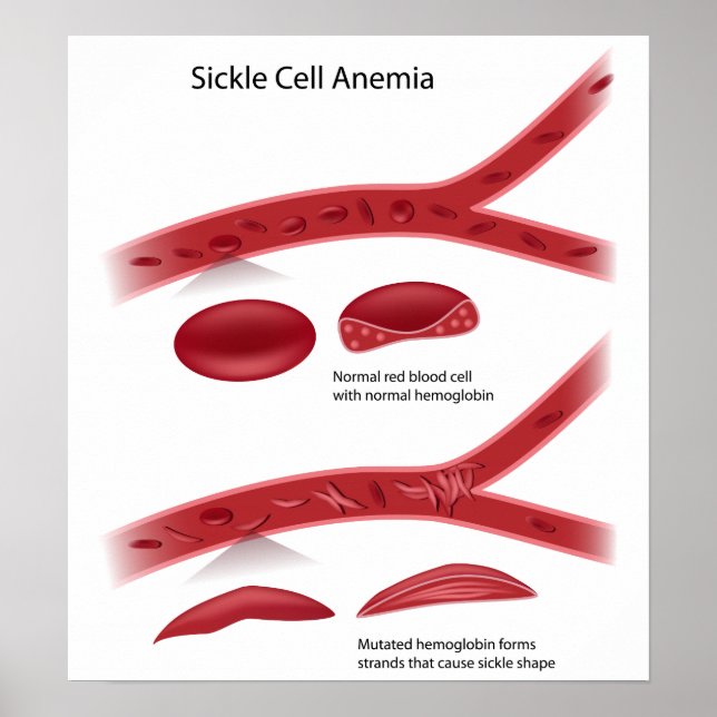 Sickle cell disease Poster (Front)