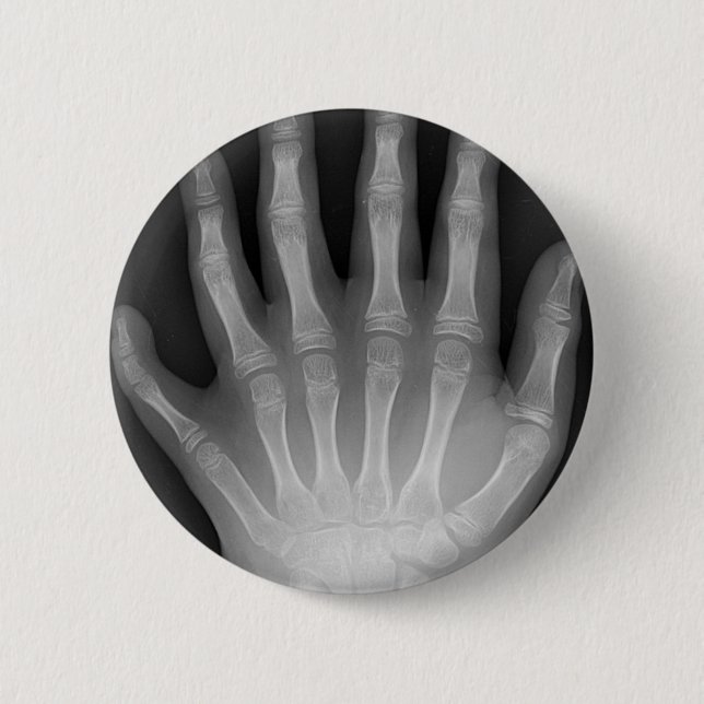 Six Fingered Hand, Medical Rarity, X-Ray Button (Front)