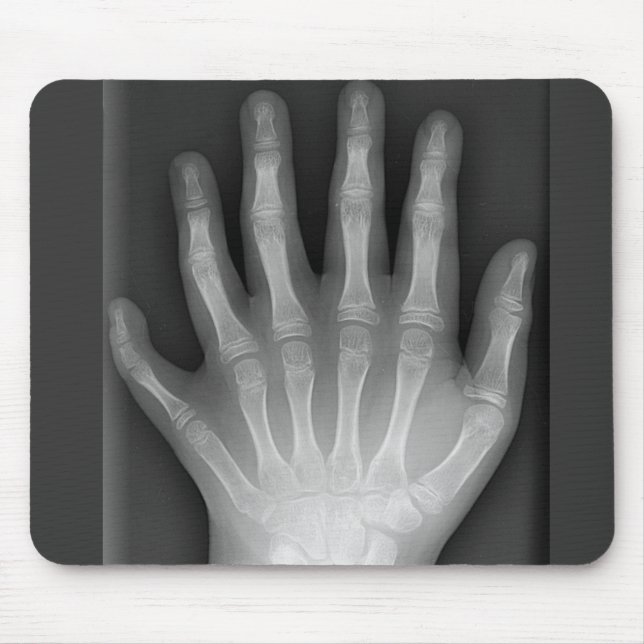 Six Fingered Hand, Medical Rarity, X-Ray Mouse Pad (Front)