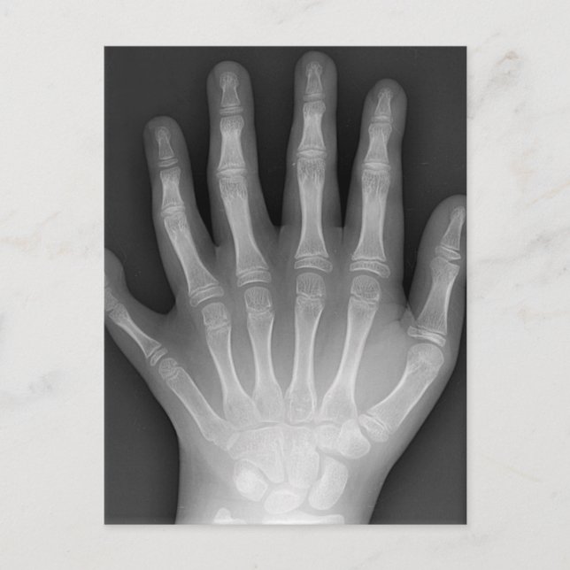 Six Fingered Hand, Medical Rarity, X-Ray Postcard (Front)