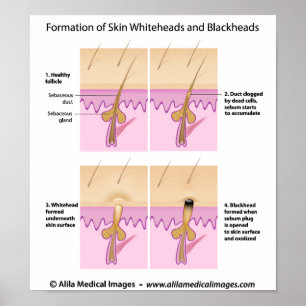 Skin blackhead Poster