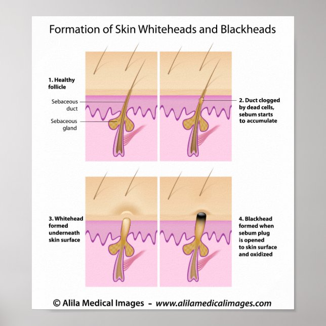Skin blackhead Poster (Front)