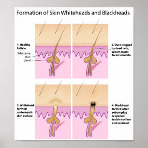 Skin blackhead Poster