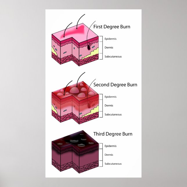 Skin Burn First Second & Third Degree Diagram Poster (Front)